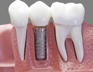 Capped Dental Implant Model